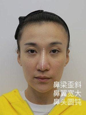 鼻樑起節女面相